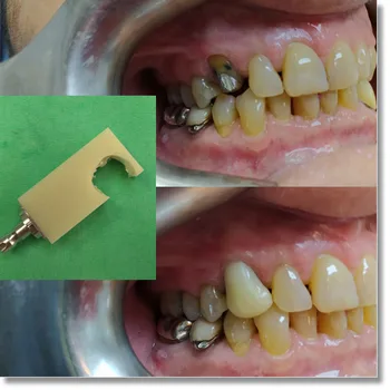 5 bucati 98 16mm PMMA monocrom disc 18 culori singură culoare PMMA dentare coroana provizorie pod