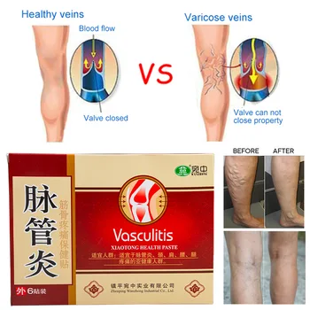 12pcs=2boxes Vene Varicoase Tratamentul Ipsos Varicoase Vasculita Chineză pe bază de Plante de Leac Autocolant Ameliorarea Durerii Medical Patch-uri D2654