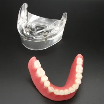 Dentare Overdenture Inferior Cu 2 Implanturi Demo De Model De Model De Studiu